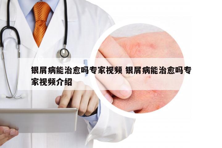 银屑病能治愈吗专家视频 银屑病能治愈吗专家视频介绍