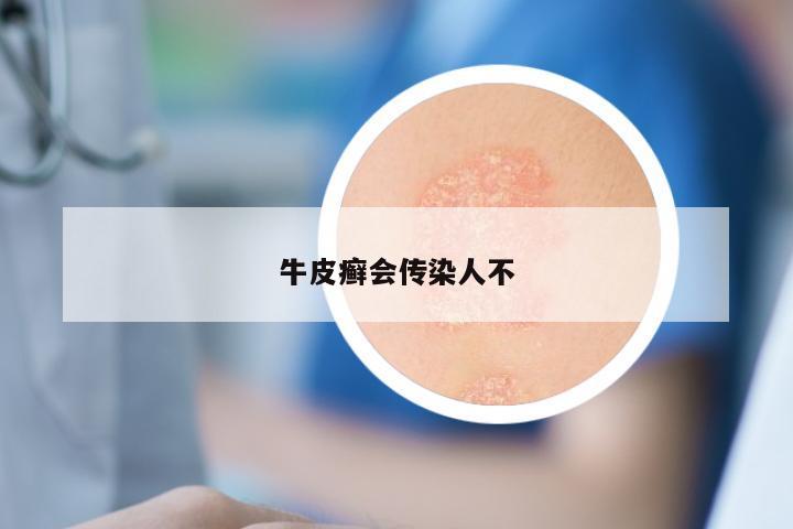 牛皮癣会传染人不