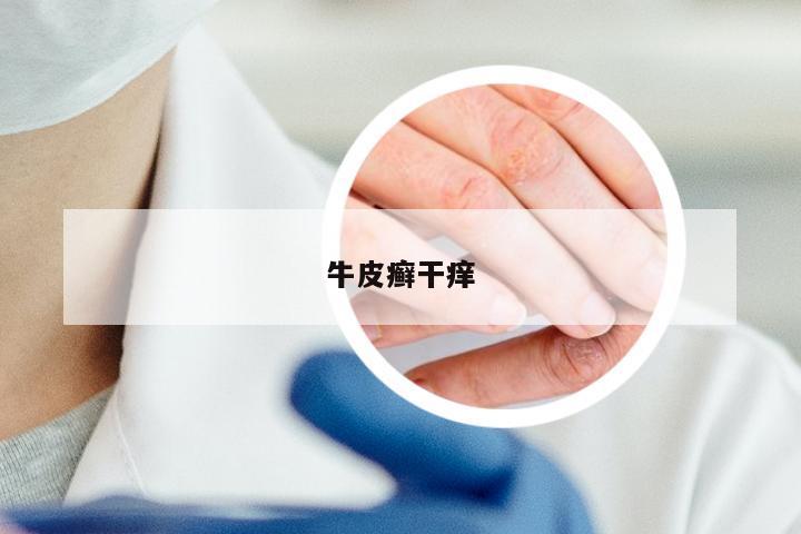 牛皮癣干痒