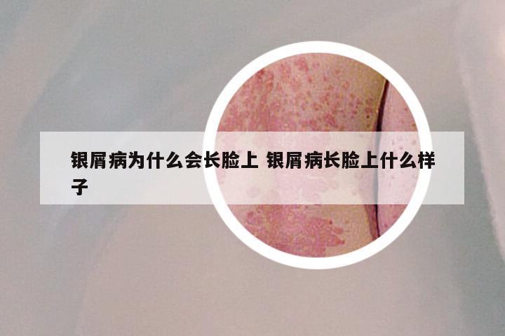 银屑病为什么会长脸上 银屑病长脸上什么样子