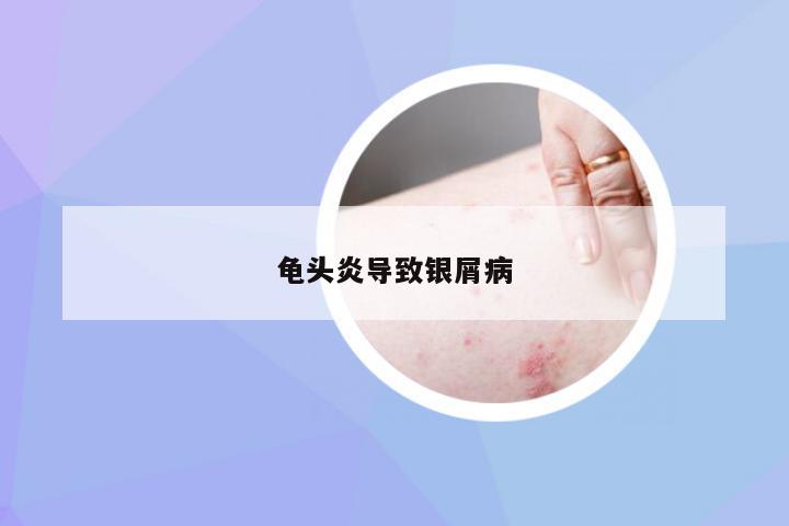 龟头炎导致银屑病