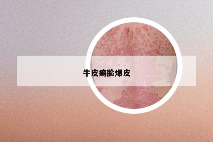 牛皮癣脸爆皮