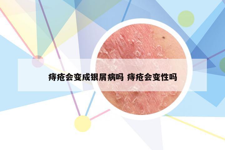 痔疮会变成银屑病吗 痔疮会变性吗