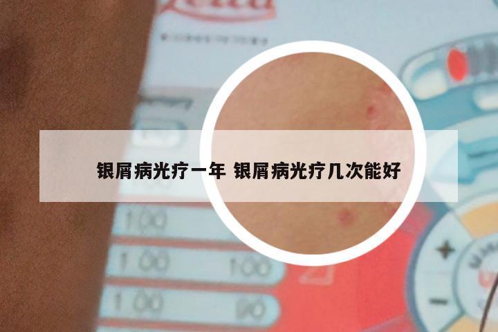 银屑病光疗一年 银屑病光疗几次能好