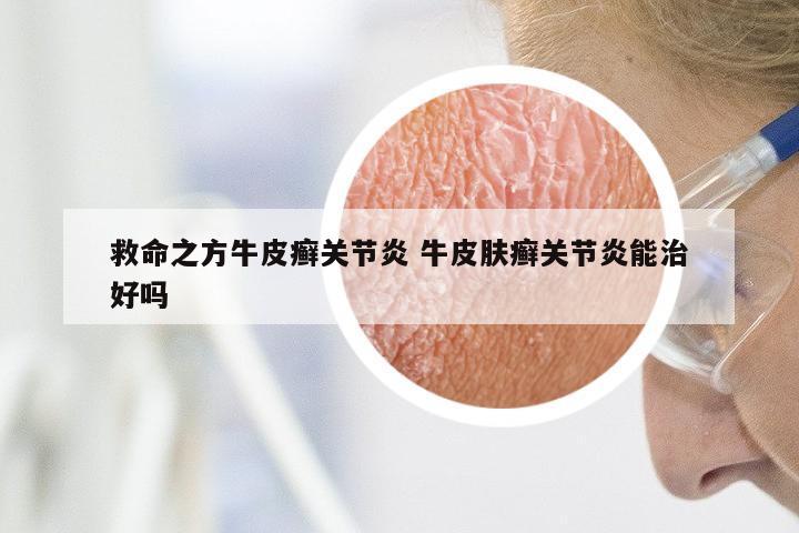救命之方牛皮癣关节炎 牛皮肤癣关节炎能治好吗