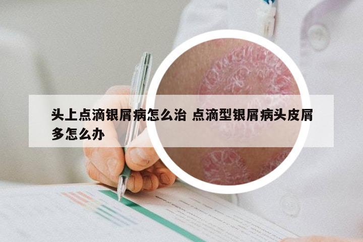 头上点滴银屑病怎么治 点滴型银屑病头皮屑多怎么办