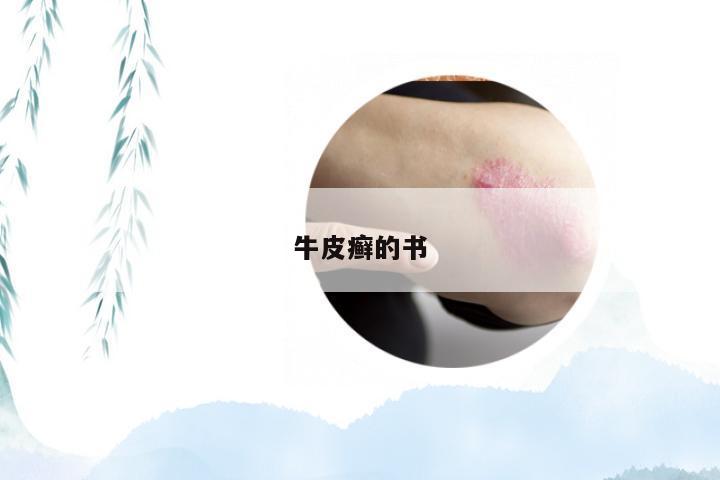 牛皮癣的书