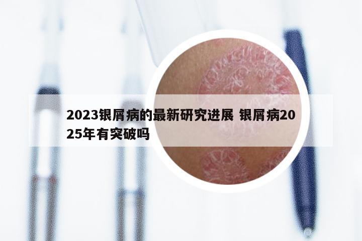 2023银屑病的最新研究进展 银屑病2025年有突破吗