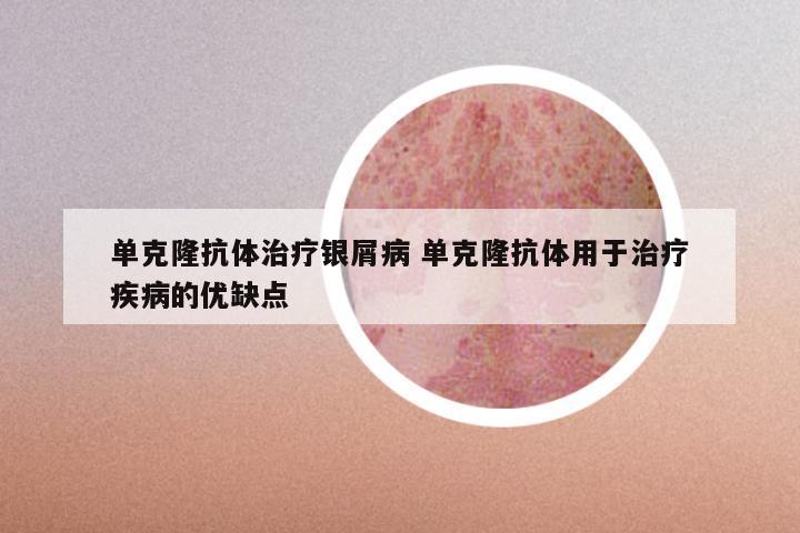 单克隆抗体治疗银屑病 单克隆抗体用于治疗疾病的优缺点