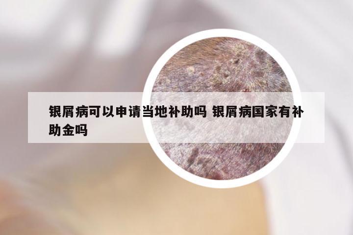 银屑病可以申请当地补助吗 银屑病国家有补助金吗