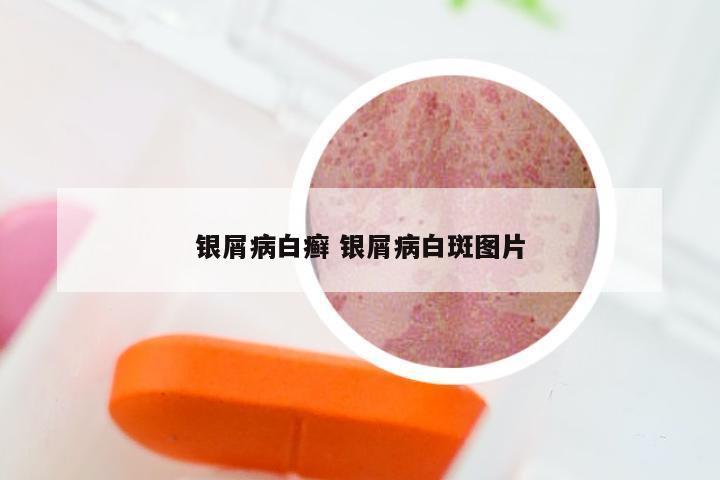 银屑病白癣 银屑病白斑图片