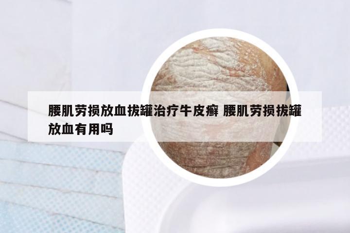 腰肌劳损放血拔罐治疗牛皮癣 腰肌劳损拔罐放血有用吗