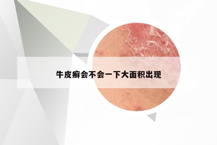 牛皮癣会不会一下大面积出现