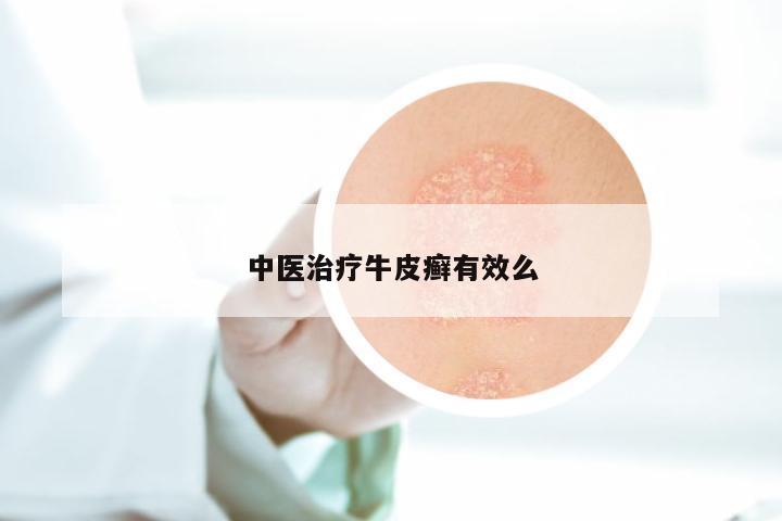 中医治疗牛皮癣有效么