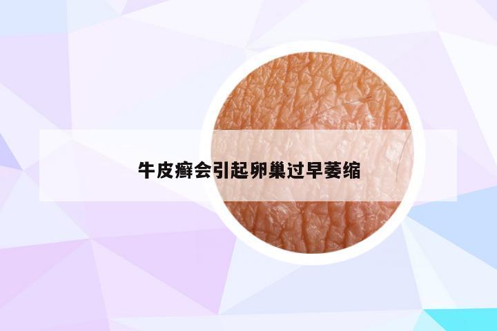 牛皮癣会引起卵巢过早萎缩