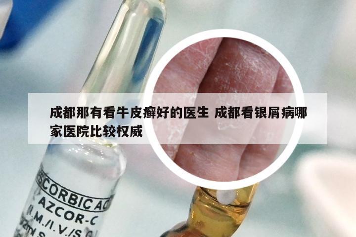 成都那有看牛皮癣好的医生 成都看银屑病哪家医院比较权威