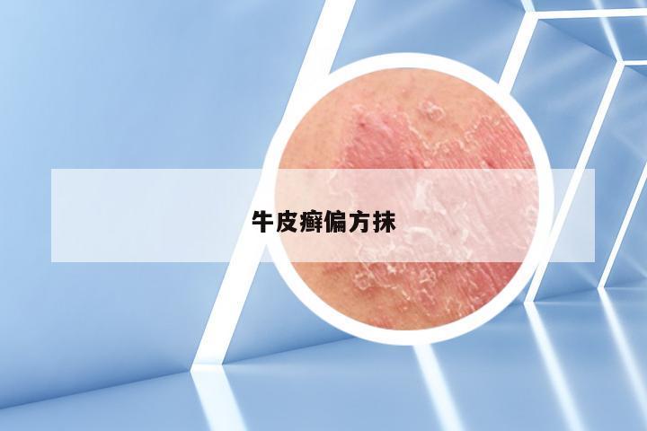 牛皮癣偏方抹