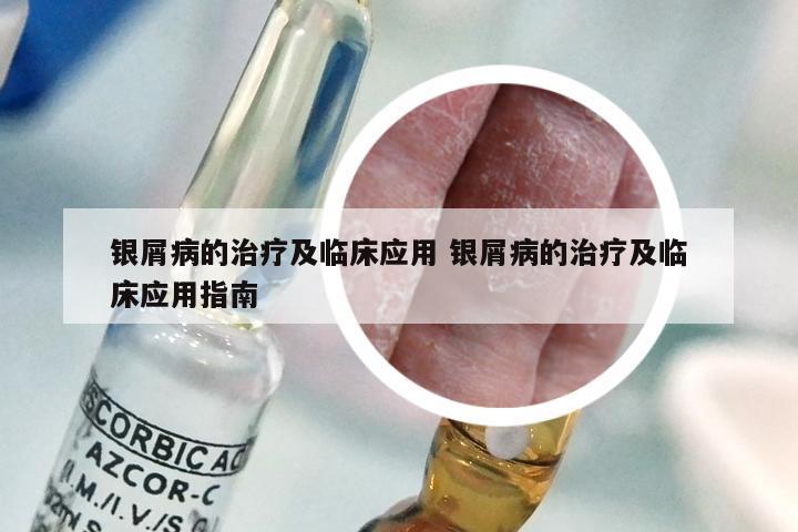 银屑病的治疗及临床应用 银屑病的治疗及临床应用指南