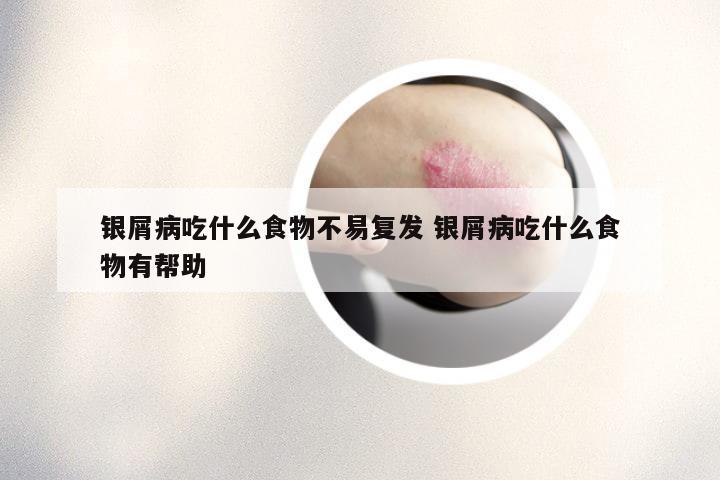 银屑病吃什么食物不易复发 银屑病吃什么食物有帮助