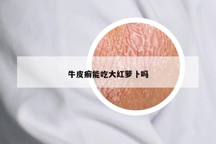 牛皮癣能吃大红萝卜吗