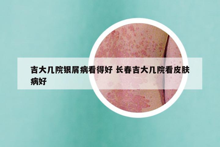 吉大几院银屑病看得好 长春吉大几院看皮肤病好