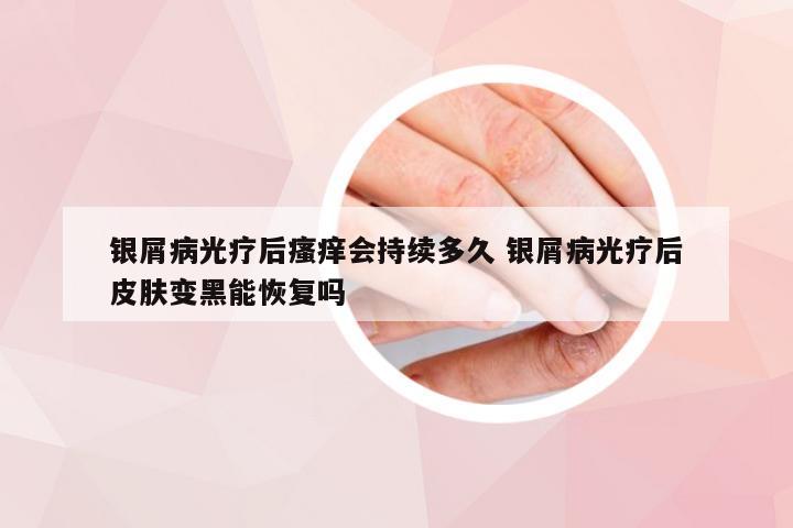 银屑病光疗后瘙痒会持续多久 银屑病光疗后皮肤变黑能恢复吗