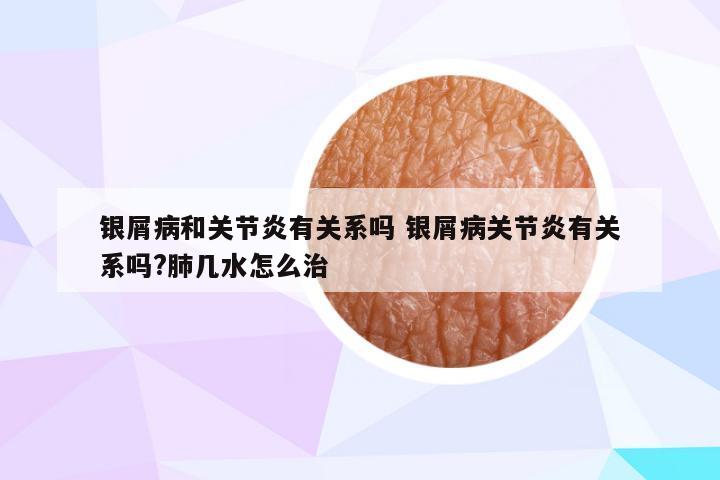 银屑病和关节炎有关系吗 银屑病关节炎有关系吗?肺几水怎么治