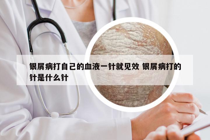 银屑病打自己的血液一针就见效 银屑病打的针是什么针