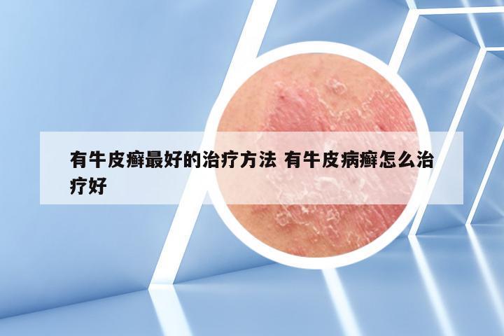 有牛皮癣最好的治疗方法 有牛皮病癣怎么治疗好