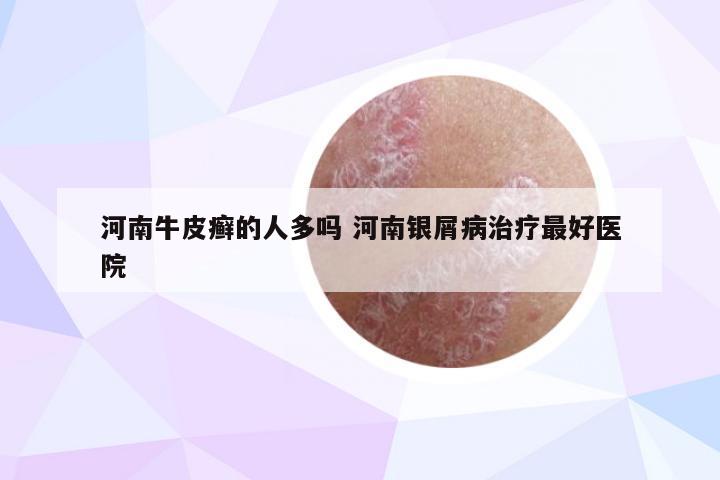 河南牛皮癣的人多吗 河南银屑病治疗最好医院