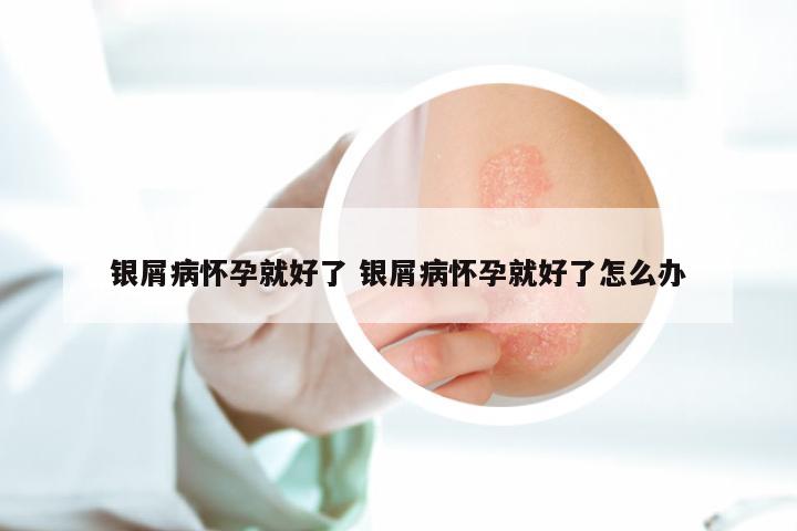 银屑病怀孕就好了 银屑病怀孕就好了怎么办