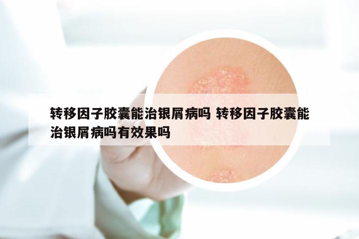 转移因子胶囊能治银屑病吗 转移因子胶囊能治银屑病吗有效果吗