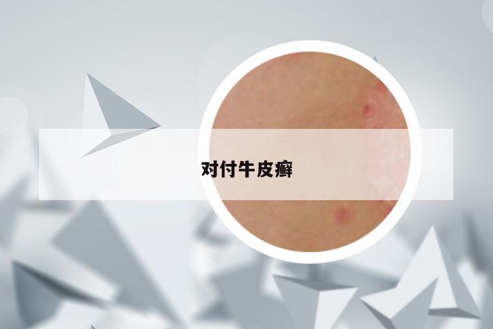 对付牛皮癣