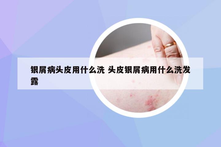 银屑病头皮用什么洗 头皮银屑病用什么洗发露