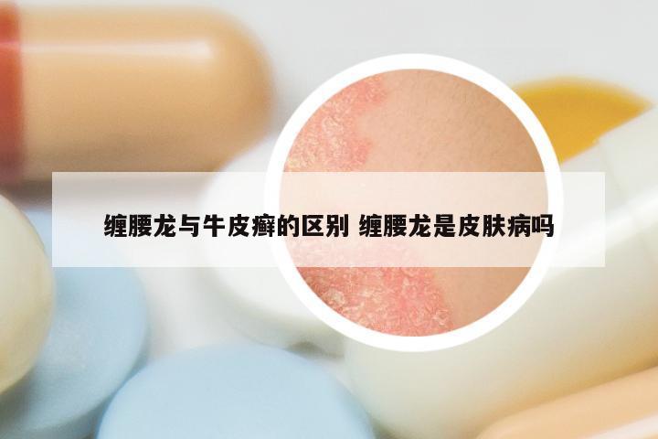 缠腰龙与牛皮癣的区别 缠腰龙是皮肤病吗