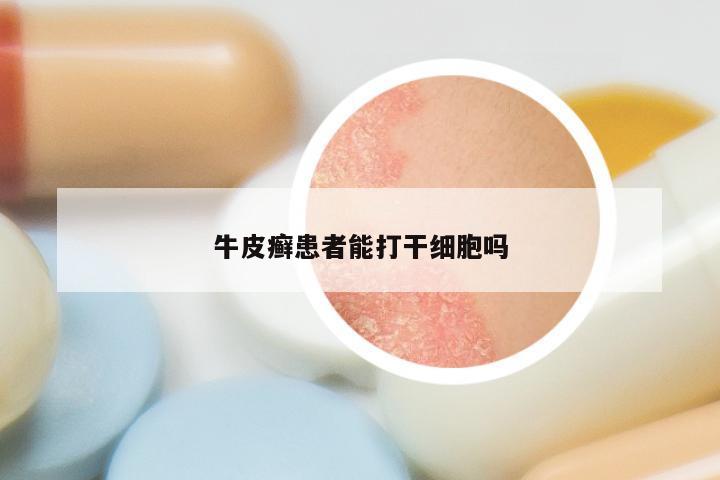 牛皮癣患者能打干细胞吗