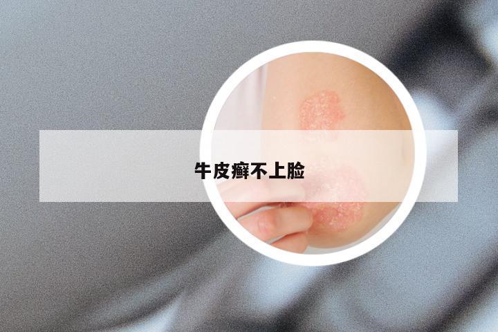 牛皮癣不上脸