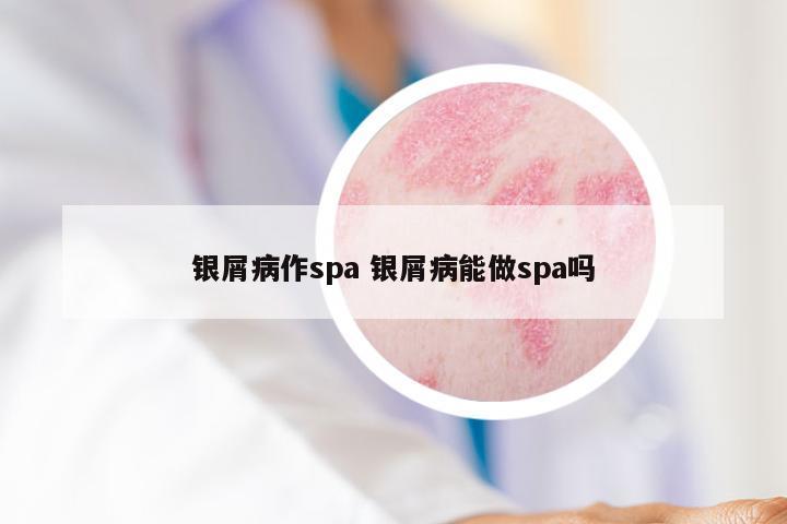 银屑病作spa 银屑病能做spa吗