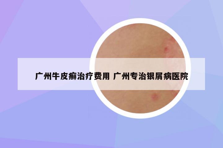 广州牛皮癣治疗费用 广州专治银屑病医院