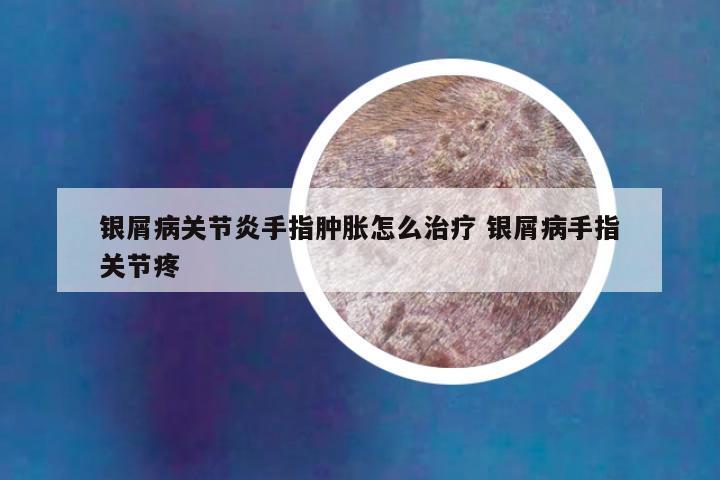 银屑病关节炎手指肿胀怎么治疗 银屑病手指关节疼