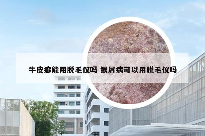 牛皮癣能用脱毛仪吗 银屑病可以用脱毛仪吗