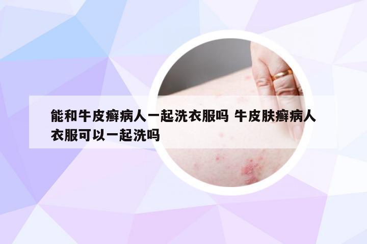 能和牛皮癣病人一起洗衣服吗 牛皮肤癣病人衣服可以一起洗吗