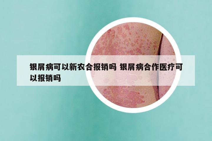 银屑病可以新农合报销吗 银屑病合作医疗可以报销吗