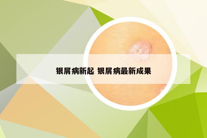 银屑病新起 银屑病最新成果