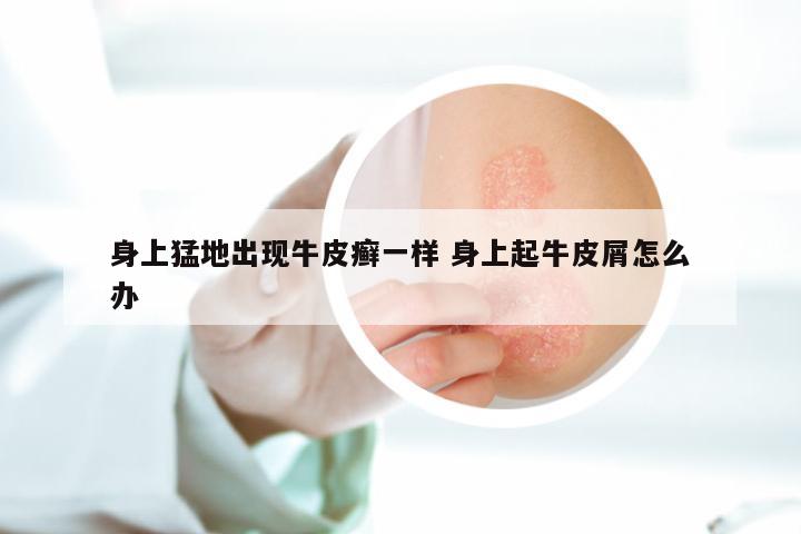 身上猛地出现牛皮癣一样 身上起牛皮屑怎么办