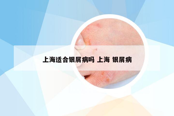 上海适合银屑病吗 上海 银屑病