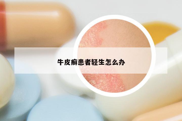 牛皮癣患者轻生怎么办