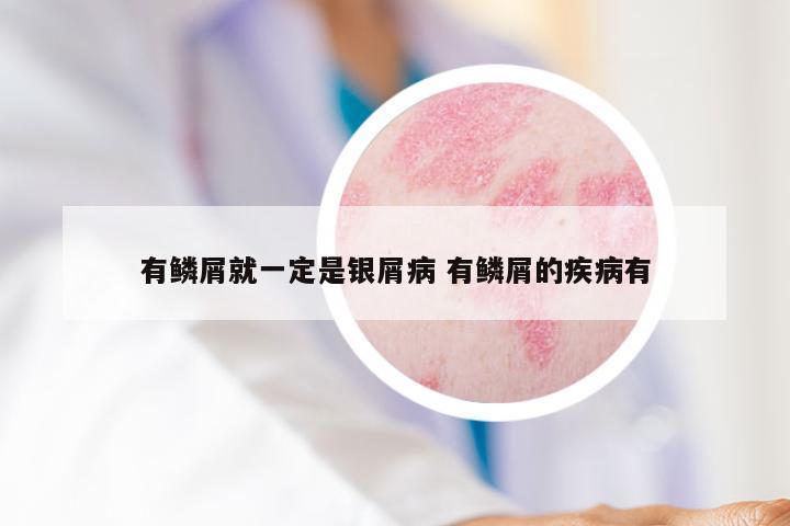 有鳞屑就一定是银屑病 有鳞屑的疾病有
