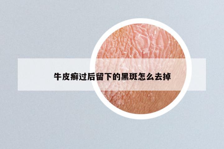 牛皮癣过后留下的黑斑怎么去掉