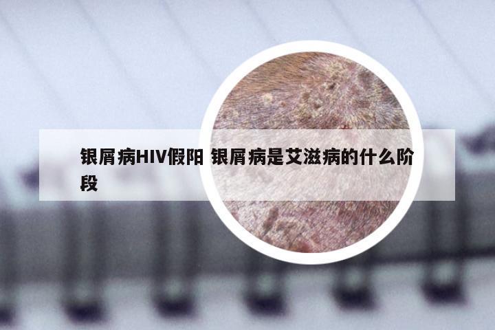 银屑病HIV假阳 银屑病是艾滋病的什么阶段
